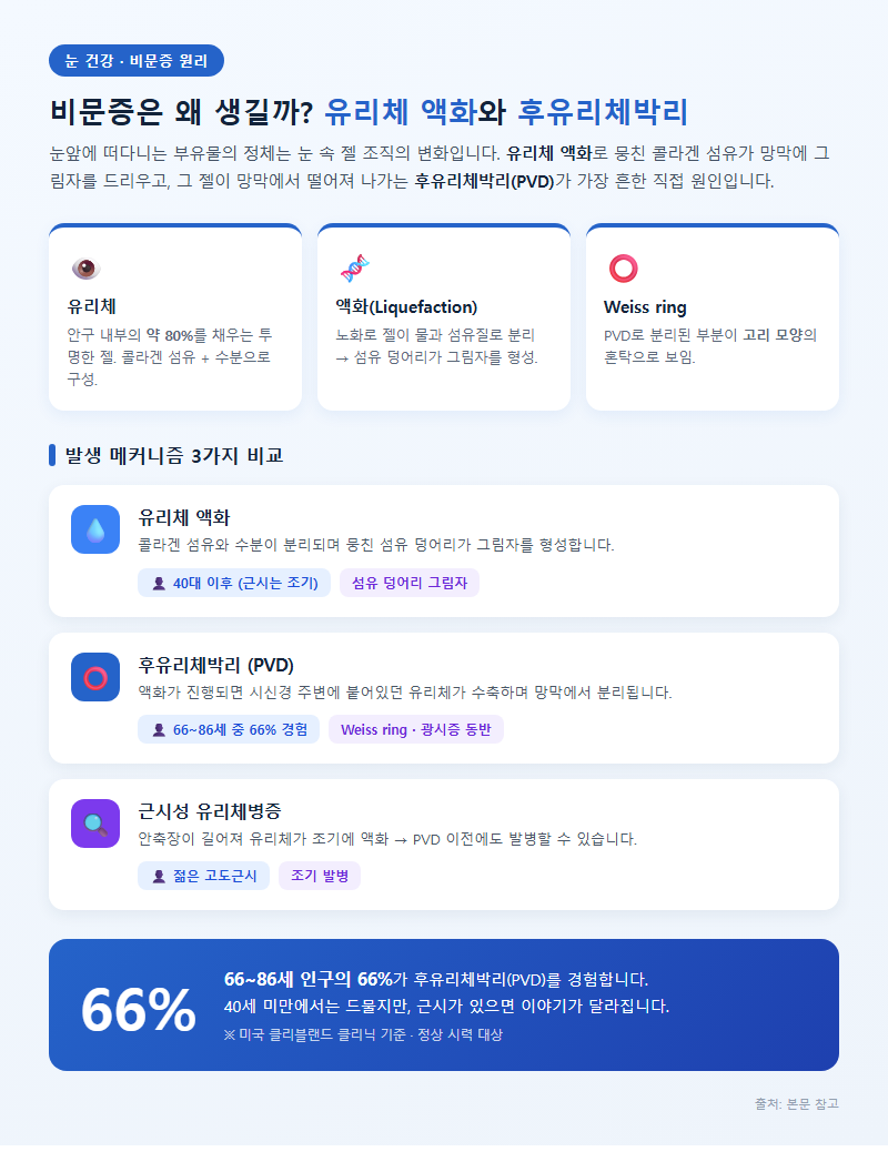 1. 비문증이 생기는 근본 원리 — 유리체 액화와 후유리체박리